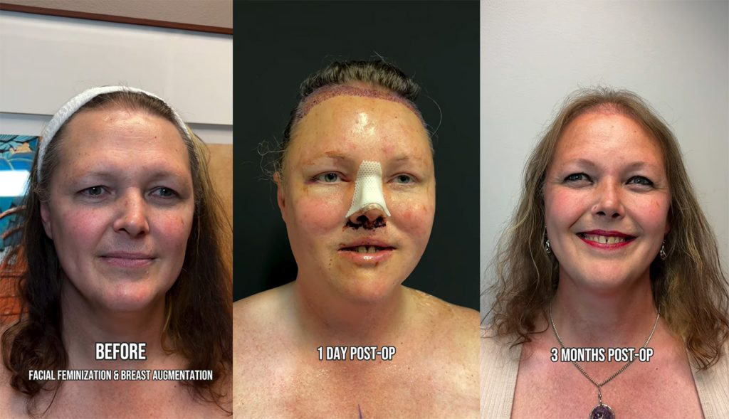 swelling after feminization surgeries