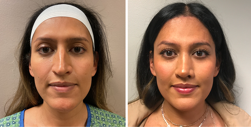 MTF Rhinoplasty (Nasal Feminization)